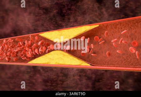 3d-Rendering Atherosklerose mit Cholesterinblut oder Plaque im Gefäß Ursache der koronaren Herzkrankheit Stockfoto