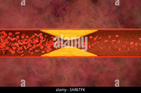 3d-Rendering Atherosklerose mit Cholesterinblut oder Plaque im Gefäß Ursache der koronaren Herzkrankheit Stockfoto