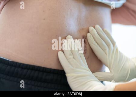 Medizinisches Fachpersonal in Handschuhen überprüft sorgfältig die Heilungseinschnitte am Rücken des Patienten und beurteilt den Fortschritt der Wunderholung Stockfoto