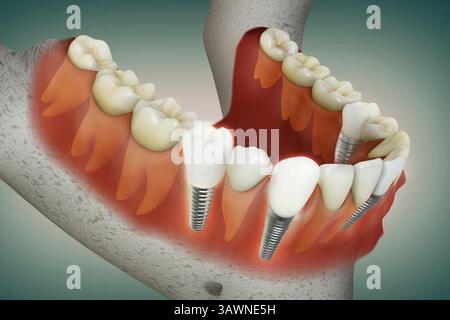 3D-Rendering-Bild von mehreren Zahnimplantaten…schön ausgerichtet auf gesunde Zähne, Zahnfleisch und Kieferknochen Stockfoto