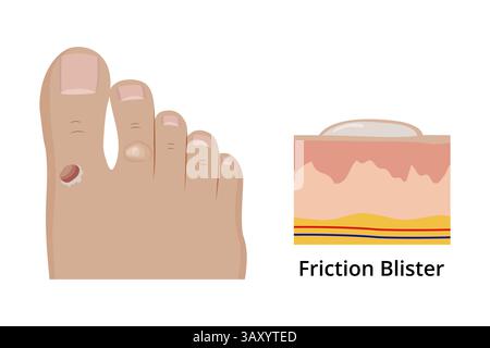 Medizinische Illustration, die zwei Stadien der Reibblase zeigt, die sich auf dem menschlichen Fuß entwickelt und detaillierte Querschnitte der Hautschichten mit Flüssigkeit gefüllte Pocke Stock Vektor