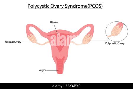 Vektorillustration des polyzystischen Ovarialsyndroms (PCOS) Stock Vektor