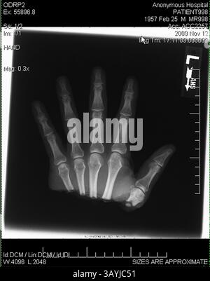 18. Dezember 2009 – Gilbert, Arizona, USA – Ärzte sagen, dass Timothy Blazer durch schnelles Denken seine linke Hand wieder befestigen konnte, nachdem er sie versehentlich mit einer Gehrungssäge durchtrennt hatte. Blazer, 52 Jahre alt, Schnitt ihm die linke Hand ab, während er an Schränken in seinem Haus in Gilbert, Arizona arbeitete. Nach dem Unfall hatte Blazer die Geistesgegenwart, seine abgetrennte Hand zu heben und sie auf Eis zu legen. Blazer sagt, dass sein Hintergrund bei den Pfadfindern und seine Ausbildung als Sicherheitsdirektor für Macy's ihm geholfen haben, ruhig zu bleiben. Chirurgen am Scottsdale Healthcare Hospital haben die Hand in einer vierstündigen Operation wieder befestigt und er hat Bewegung in allen Stockfoto
