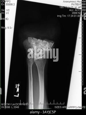 18. Dezember 2009 – Gilbert, Arizona, USA – Ärzte sagen, dass Timothy Blazer durch schnelles Denken seine linke Hand wieder befestigen konnte, nachdem er sie versehentlich mit einer Gehrungssäge durchtrennt hatte. Blazer, 52 Jahre alt, Schnitt ihm die linke Hand ab, während er an Schränken in seinem Haus in Gilbert, Arizona arbeitete. Nach dem Unfall hatte Blazer die Geistesgegenwart, seine abgetrennte Hand zu heben und sie auf Eis zu legen. Blazer sagt, dass sein Hintergrund bei den Pfadfindern und seine Ausbildung als Sicherheitsdirektor für Macy's ihm geholfen haben, ruhig zu bleiben. Chirurgen am Scottsdale Healthcare Hospital haben die Hand in einer vierstündigen Operation wieder befestigt und er hat Bewegung in allen Stockfoto