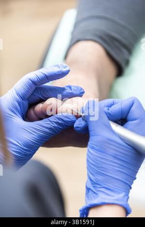 Podologe mit blauen Handschuhen mit einem elektrischen Gerät zur Durchführung einer eingewachsenen Zehennagel-Behandlung am Fuß eines Patienten Stockfoto