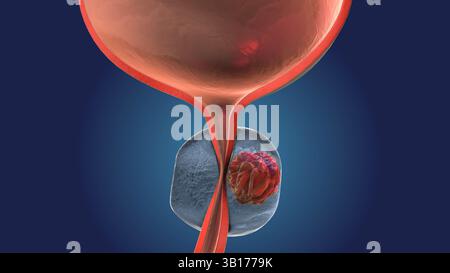 Blasenfunktion beeinflusst durch Prostatakarzinom Stockfoto
