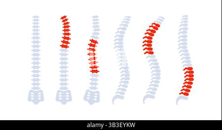 Wirbelsäulenknochen mit Rückenschmerzen, die unterschiedliche Probleme zeigen Stock Vektor