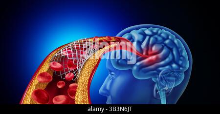 Stenting für Gehirn- oder neurovaskuläre Stents und zerebrale Angioplastie zur Aufrechterhaltung des Blutflusses in einem blockierten Blutgefäß als medizinisches Illustrationskonzept Stockfoto