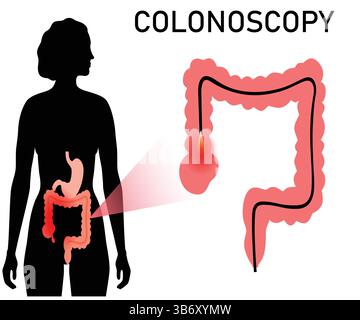 Koloskopie-Verfahren medizinischer Vektor – Verdauungssystem Untersuchung und Darmgesundheit Illustration. Editierbarer Vektorstrich EPS10 Stock Vektor