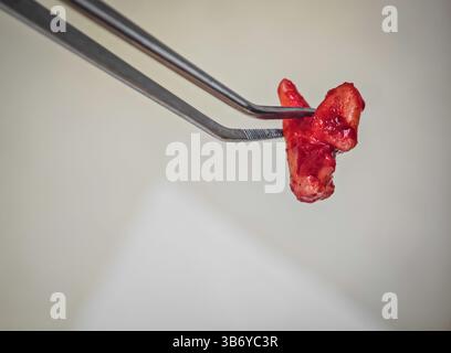 Extrahierter Zahn. Weisheitszahn nach Entfernungsoperation mit medizinischer Pinzette Stockfoto