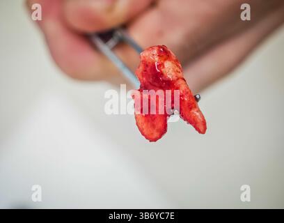 Extrahierter Zahn. Weisheitszahn nach Entfernungsoperation mit medizinischer Pinzette Stockfoto