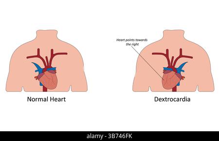 Dextrokardie-Vektorillustration Stock Vektor