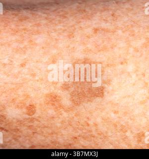 Sommersprossen und grosse Hautflecken am Arm des älteren Mannes. Stockfoto