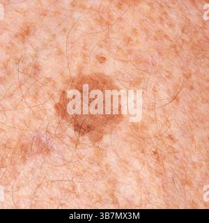 Sommersprossen und grosse Hautflecken am Bein des älteren Mannes. Stockfoto