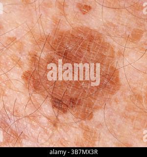 Sommersprossen und grosse Hautflecken am Bein des älteren Mannes. Stockfoto