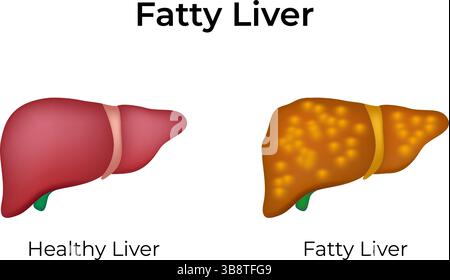 Fettleber vs gesunde Leber Design Vektor Illustration Stock Vektor