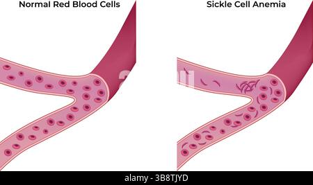Vergleich normaler Erythrozyten und Sichelzellanämie Vektorillustration Stock Vektor