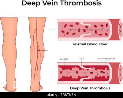 Tiefe Venenthrombose Blutgerinnsel in der Vektor-Illustration verstehen Stock Vektor
