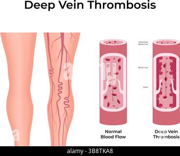 Tiefe Venenthrombose Blutgerinnsel in der Vektor-Illustration verstehen Stock Vektor