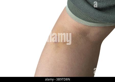 Nahaufnahme eines menschlichen Arms mit sichtbarem subkutanen Bluterguss in der Nähe der Ellenbogenfalte, wahrscheinlich verursacht durch Komplikation nach der Injektion oder Blutentnahme. Stockfoto