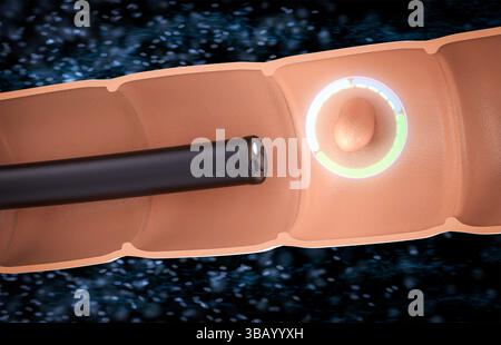 3D-Rendering-Endoskop mit Kolonpolyp im Darm Stockfoto