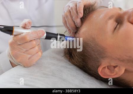Alopezie. Der Haarausfall des Mannes verbessert die Regeneration der Wachstumsbehandlung, Dermapen-Mikroneedling, Vitamin-Exosomen-Plasmainjektionen. Trichologe Kosmetologe Arzt KopfKopfKopfhautverfahren fraktionelle Mesotherapie Stockfoto