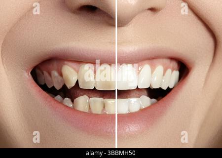 Frau Zähne vor und nach dem Aufhellung. Perfektes Lächeln mit gesunden Zähnen. Patient In Der Zahnklinik. Mundpflege Zahnheilkunde Stockfoto