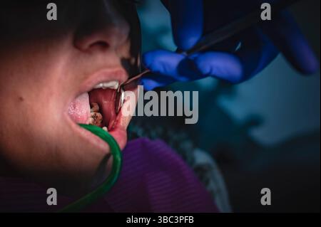 Zahnbehandlung Karies Zahn eine Nahaufnahme der Zahnbehandlung und Mundpflege, die den Schwerpunkt Zahnhygiene und Gesundheit legt Stockfoto