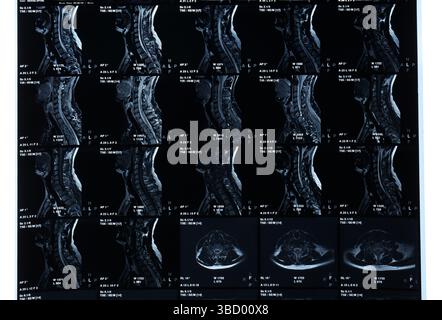 MRT-Scan der Wirbelsäule auf weißem Hintergrund Stockfoto