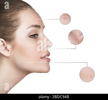 Weibliches Gesicht mit Zoomkreisen isoliert auf weißem Hintergrund. Problemhautkonzept Stockfoto