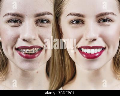 Junge Frau mit perfekten Zähnen vor und nach Zahnspangen Stockfoto