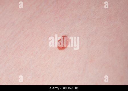Ein gutartiger Maulwurf am Körper. Ärztliche Untersuchung. Dermatologe. Onkologe. Stockfoto