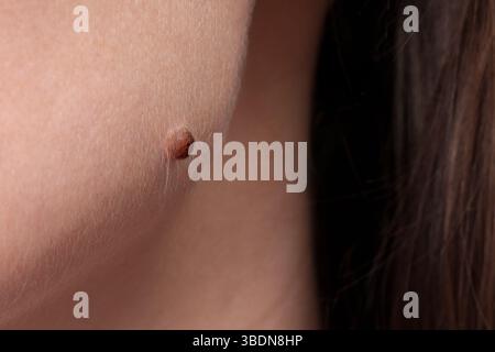 Eine Frau hat einen großen Maulwurf im Gesicht. Ein Tumor am Körper. Ein Beispiel für einen Maulwurf. Stockfoto