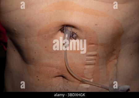 Nahaufnahme eines männlichen Abdomens mit einer perkutanen endoskopischen Gastrostomie-Sonde (PEG), die zur langfristigen Ernährungsunterstützung verwendet wird. Stockfoto