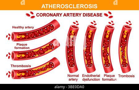 Arteriosklerose koronare Herzkrankheit, blockieren arterielle Blutgefäße Cholesterinplaque, Herzgesundheit. Thrombosevektor des kardiovaskulären Systems Stock Vektor