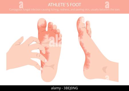 Fußathlet. Hautzustand Tinea pedis. Hautkrankheiten. Medizinische Infografik. Vektorabbildung Stock Vektor