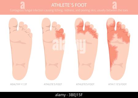 Fußathlet. Hautzustand Tinea pedis. Hautkrankheiten. Medizinische Infografik. Vektorabbildung Stock Vektor