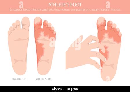 Fußathlet. Hautzustand Tinea pedis. Hautkrankheiten. Medizinische Infografik. Vektorabbildung Stock Vektor