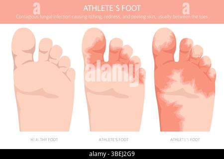 Fußathlet. Hautzustand Tinea pedis. Hautkrankheiten. Medizinische Infografik. Vektorabbildung Stock Vektor