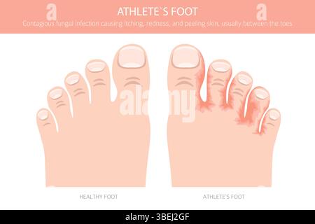 Fußathlet. Hautzustand Tinea pedis. Hautkrankheiten. Medizinische Infografik. Vektorabbildung Stock Vektor