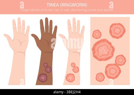 Tinea. Ringelflechte. Hautkrankheiten. Medizinische Infografik. Vektorabbildung Stock Vektor