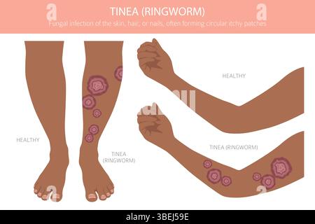 Tinea. Ringelflechte. Hautkrankheiten. Medizinische Infografik. Vektorabbildung Stock Vektor