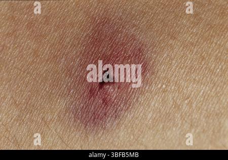 Blutegelbiss (Hirudo medicinalis) Stockfoto