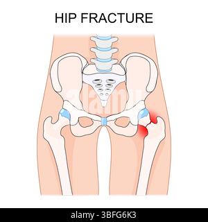 Hüftfraktur. Proximale Femurfraktur. Schenkelhalsfraktur. Stock Vektor
