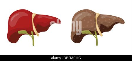 Vergleich zwischen gesunder Leber und mit Zirrhose, die schwere Schäden durch chronische Lebererkrankung, medizinische und pädagogische Stock Vektor