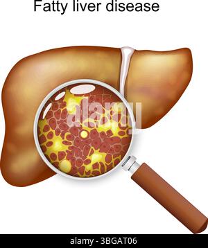 Die Fettlebererkrankung. Hepatische Steatose. Unter einer Lupe lagern sich Zellen und überschüssiges Fett in der Leber an. Schematische Darstellung. Medizinisches Diagramm. Stock Vektor