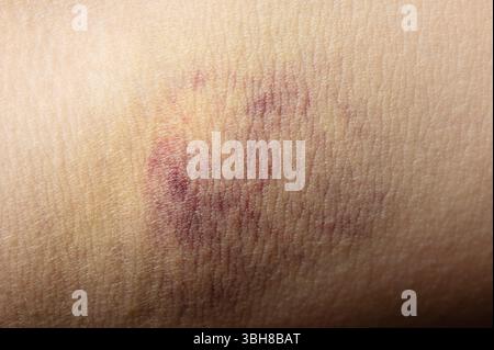 Rote blaue Flecken auf der menschlichen Haut Makronahtansicht Stockfoto