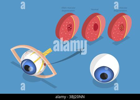 3D Isometrische flache Darstellung altersbedingter Makuladegeneration, Augenkrankheit, Sehproblem Stockfoto