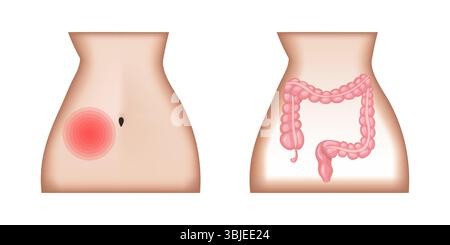 Appendizitis mit Schmerzen im rechten unteren Bauchtrantenquadranten und entzündeter Appendix Stock Vektor