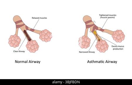 Illustration des Asthmavektors Stock Vektor